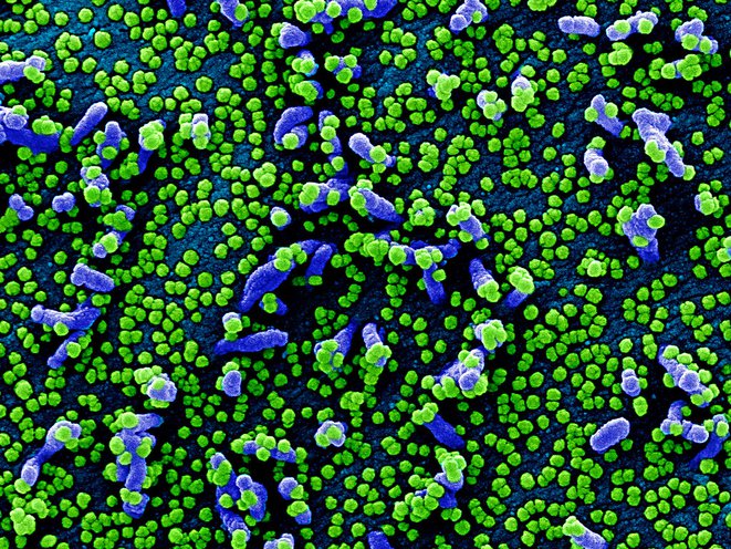 Colorized scanning electron micrograph of a VERO E6 cell (blue) heavily infected with SARS-COV-2 virus particles (green), isolated from a patient sample. Image captured and color-enhanced at the NIAID Integrated Research Facility (IRF) in Fort Detrick, Maryland.