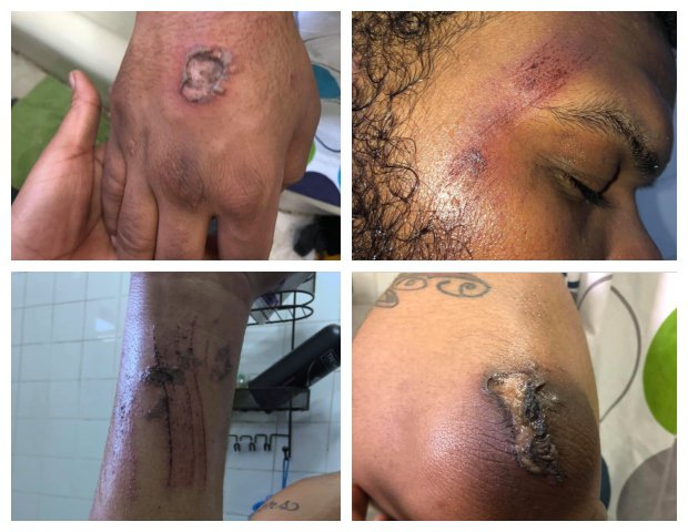 Four photos of the 20-year-old's injuries provided by his lawyer.